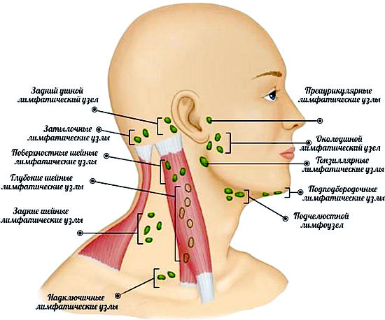 Воспаление лимфоузлов на шее - лечение, симптомы лимфаденита