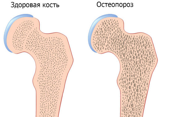 Профилактика остеопороза у женщин после 45