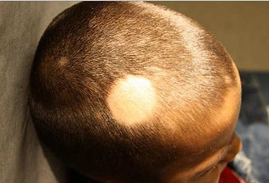 причины выпадения волос у детей