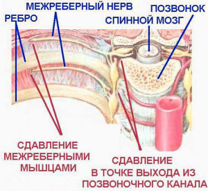 Межреберная невралгия на фоне стресса