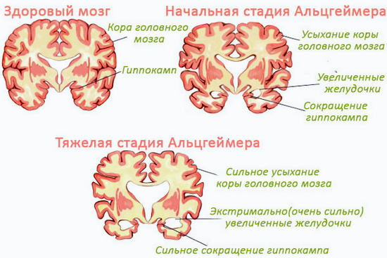болезнь альцгеймера симптомы
