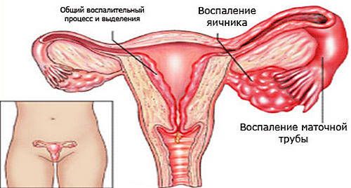 воспаление яичников у женщин