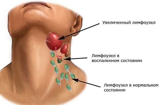 воспаление лимфоузлов на шее