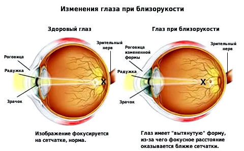 Профилактика близорукости у детей: как предотвратить проблемы с зрением