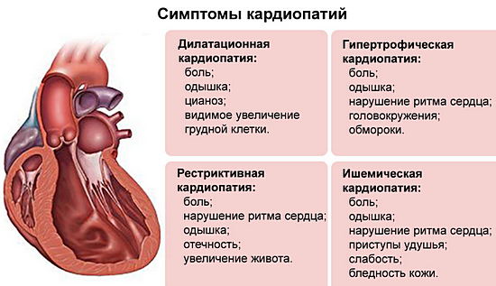 симптомы кардиопатии