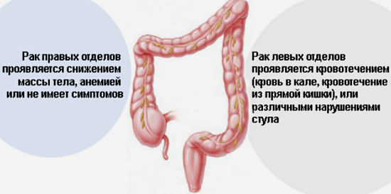симптомы рака кишечника