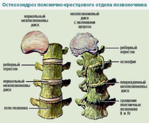 Остеохондроз поясничного отдела фото