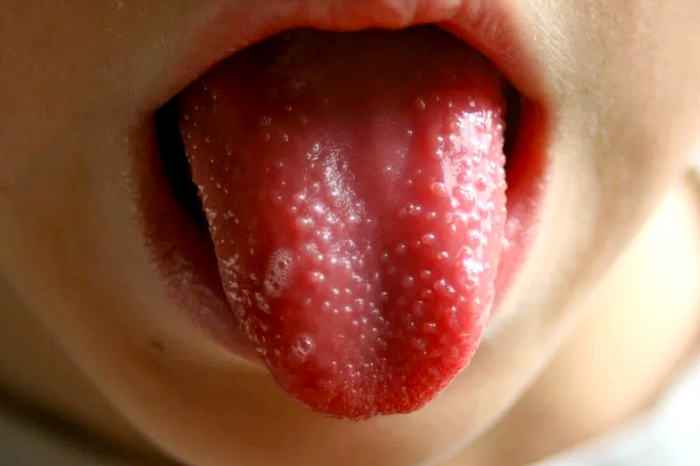 малиновый язык при скарлатине