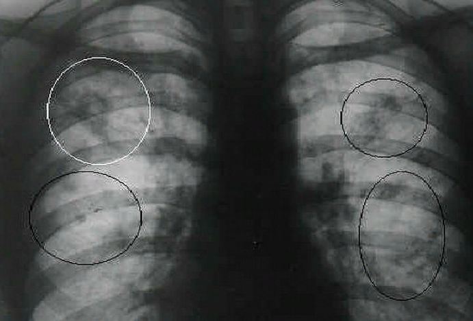 что показывает рентген при туберкулезе