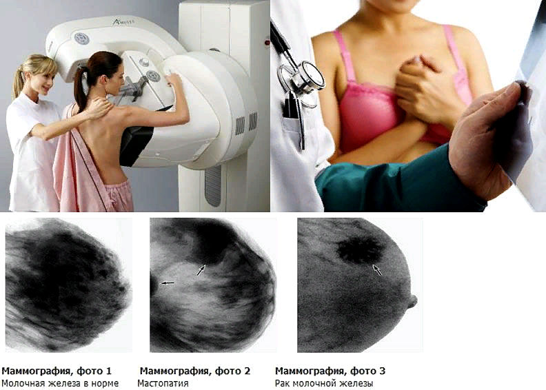 маммография - процедура, показания