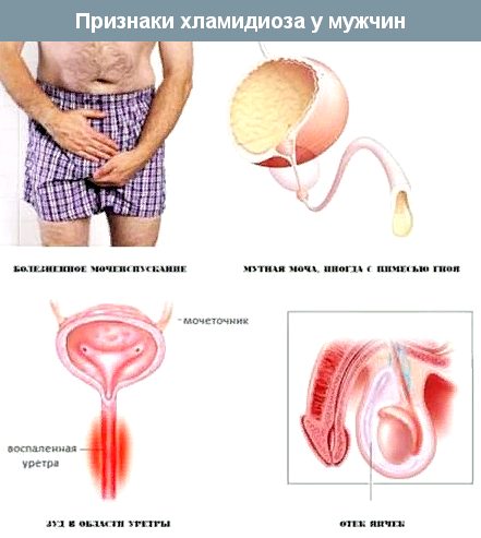 симптомы хламидиоза у мужчин