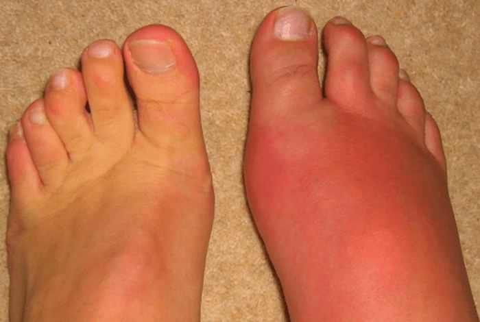 Рожа на ноге (рожистое воспаление) – причины, симптомы, лечение