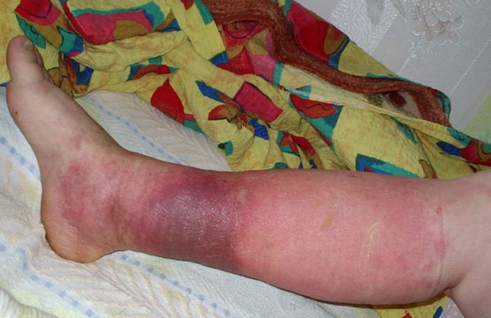 симптомы рожистого воспаления ноги