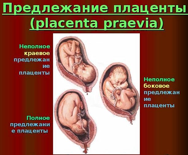 виды предлежания плаценты