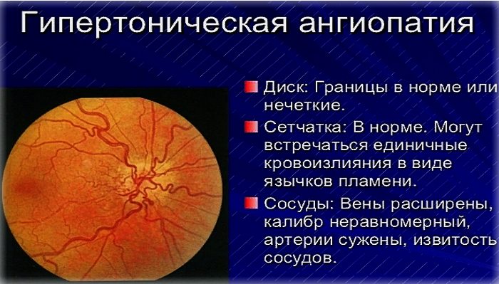 Ангиопатия сетчатки глаза лечение в домашних условиях thumbnail