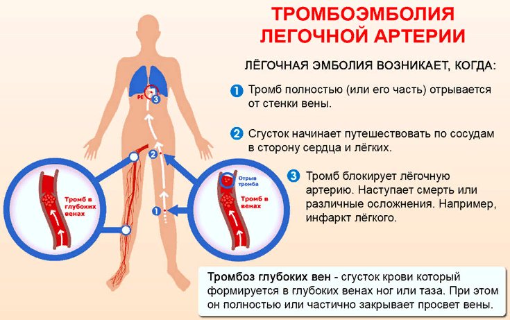 что такое тромбоэмболия легочной артерии