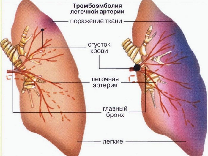 лечение тромбоэмболии легочной артерии