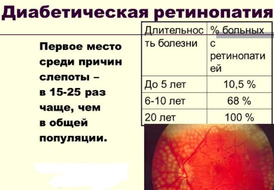 ретинопатия при диабете