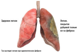 Опасен ли фиброз легких для жизни после ковида