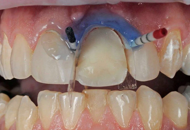 преимущества зубного протезирования