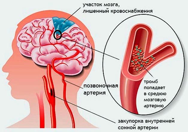 ишемия сосудов головного мозга