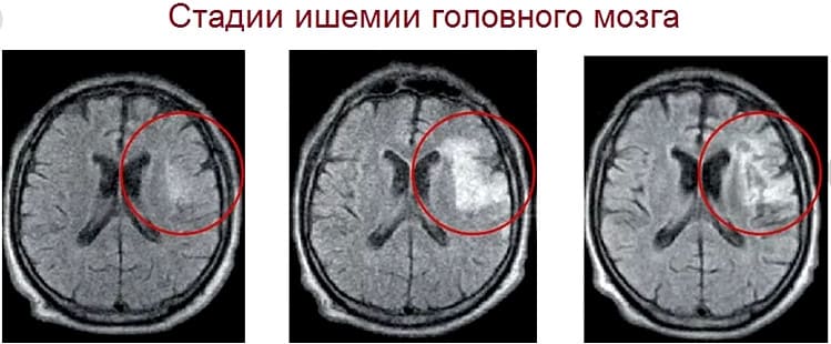 стадии ишемии головного мозга