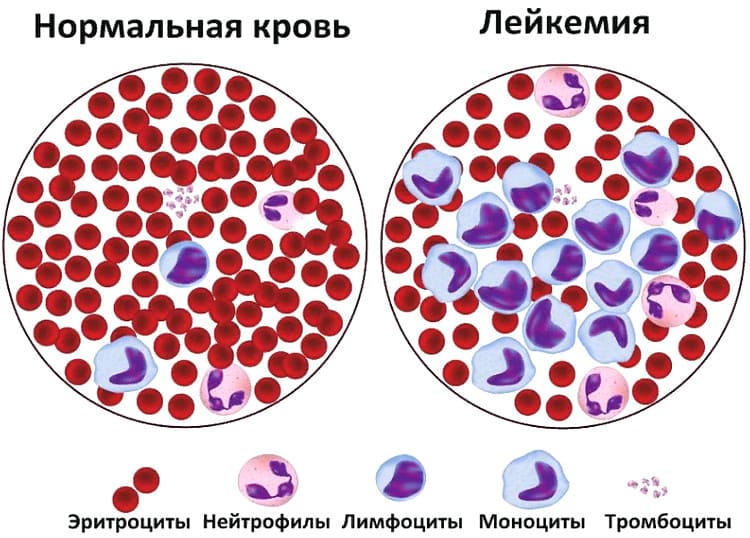 рак крови - лейкемия (лейкоз)